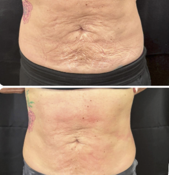 Midsection — tone & texture improvement